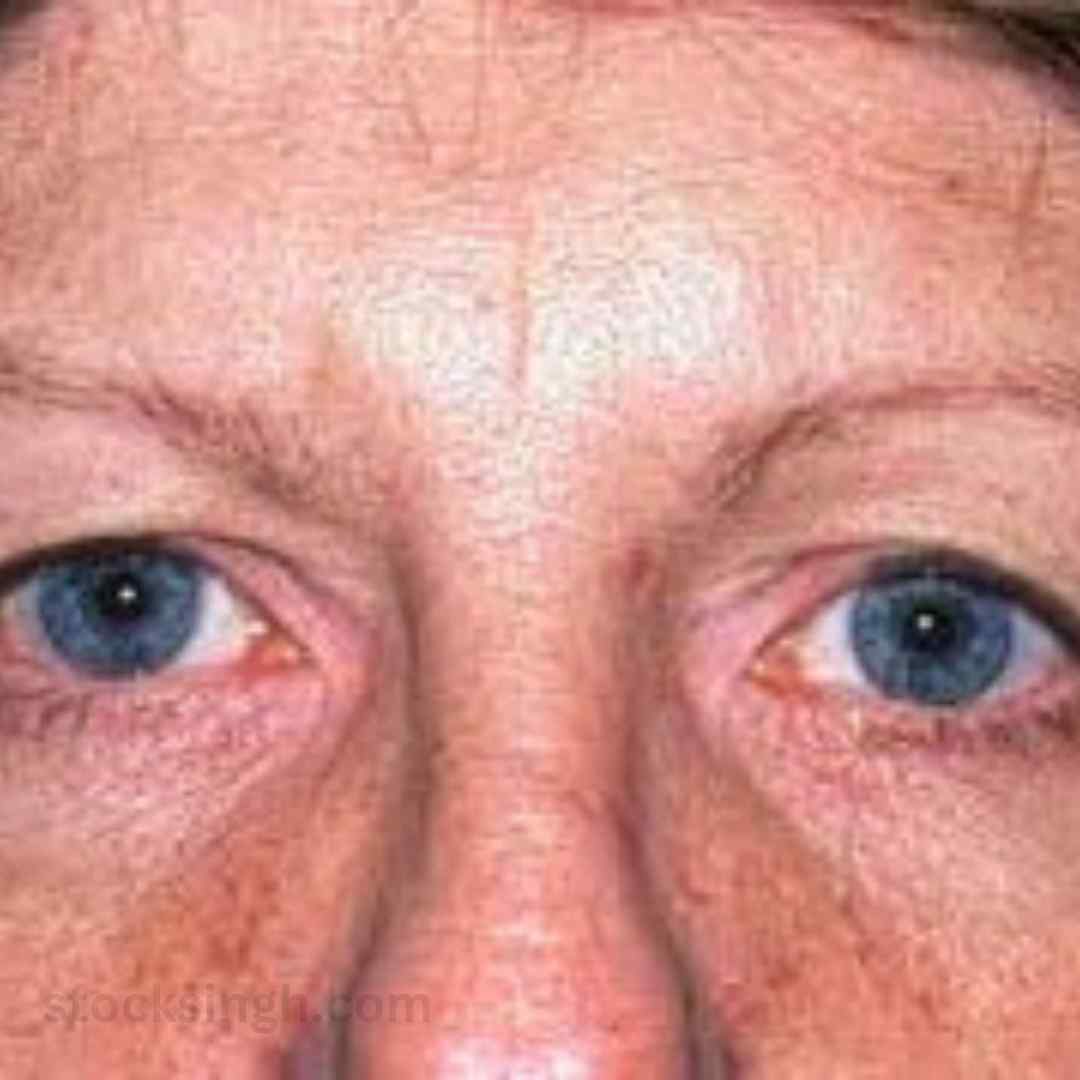 images of eyelid surgery covered by insurance